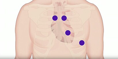 Illustration of chest with auscultation locations indicated with blue dots.
