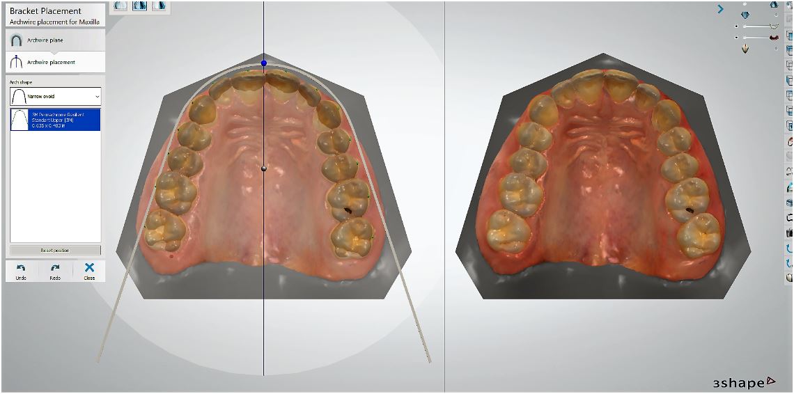 Use digital scans to either create customized bonding trays or work with a lab to provide trays