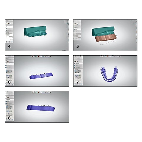 Bonding tray creation with the 3Shape Appliance Designer software