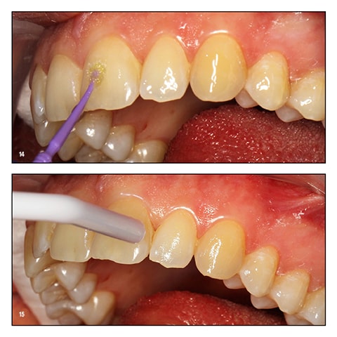 Light cure directly through the bonding tray and ceramic brackets.