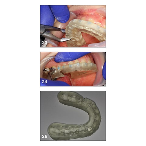 Tray removal after curing is straightforward