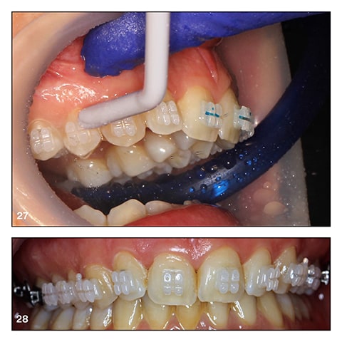 With no cured flash to grind off, last steps are to rinse the teeth and install the archwire