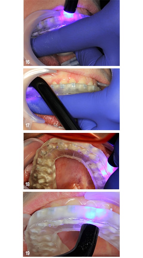 Light cure directly through the bonding tray and ceramic brackets.