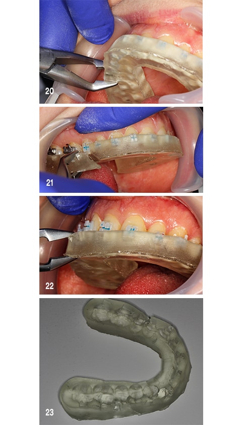 Remove the bonding tray after curing.