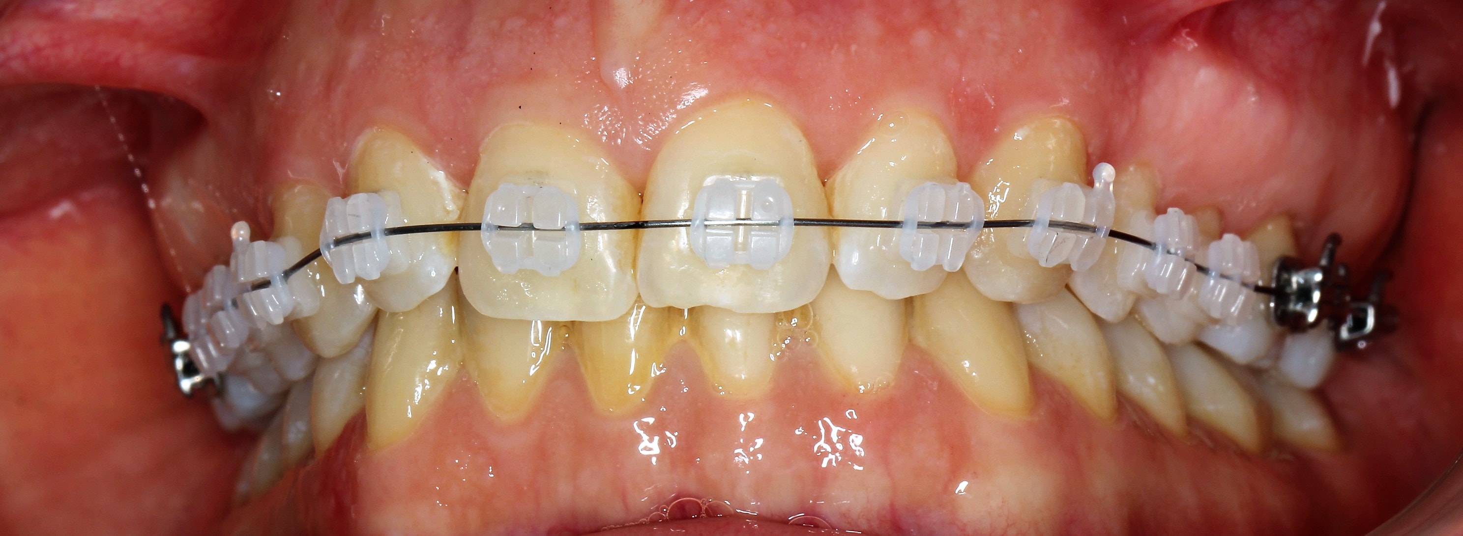 Install archwire and complete the bonding appointment, with no cured flash to grind away.