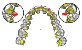 Drawing of new archwire bends