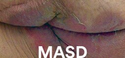 Example of MASD.