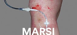 Example of MARSI.
