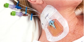 prevention of bloodstream infections 
