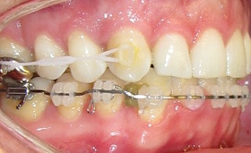 3M Clarity Advanced Brackets on lower