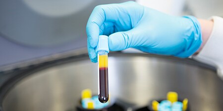 Vial taken out of centrifuge showing plasma is separated from other blood components
