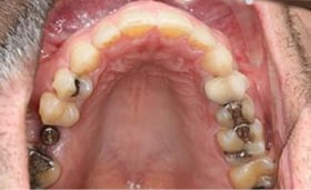 A patient&rsquo;s teeth 4 months into orthdontic treatment