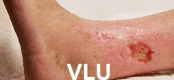 Example of VLU.