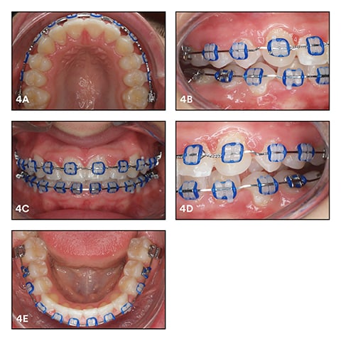 Situation in September 2015 with finishing steps in the archwires, a steel ligature applied in a figure-8 pattern in the maxillary anterior region and elastic ligatures in the color midnight glow