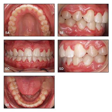 Intraoral situation immediately after debonding of the brackets and the placement of fixed retainers