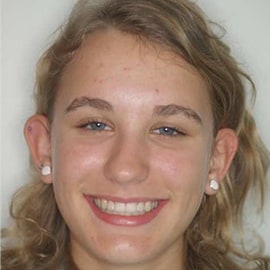 You can observe the greatly improved smile line and profile of the patient