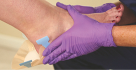 Clinician applying Tagerderm to a pressure injury