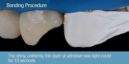 3m filtek Z350XT universal and flowable composite with one bulk fill restorative
