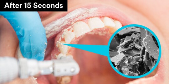 Perlite particle breakdown during dental prophylaxis
