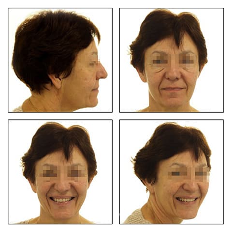 Figures 4A-D: Extraoral photos