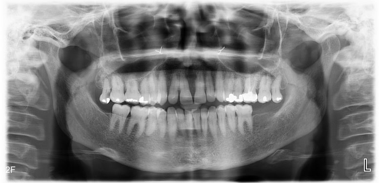 Figure 2F: Phase II dental panorex