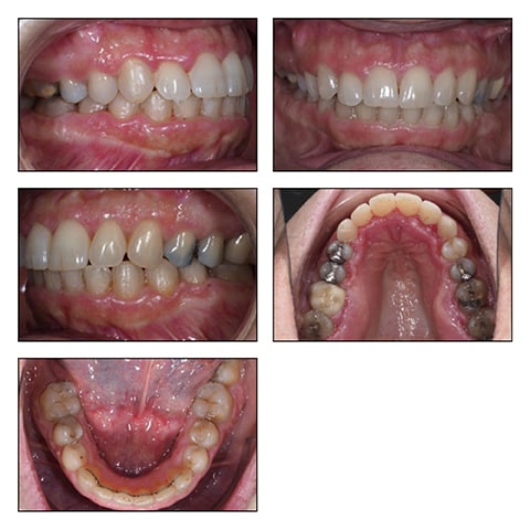 Figures 4E-I: Intraoral photos