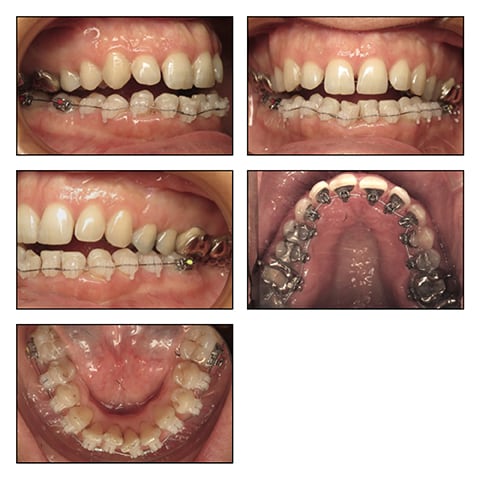 Figures 2A&rsquo;-E&rsquo;: Intraoral photos with 0,14 NITI.