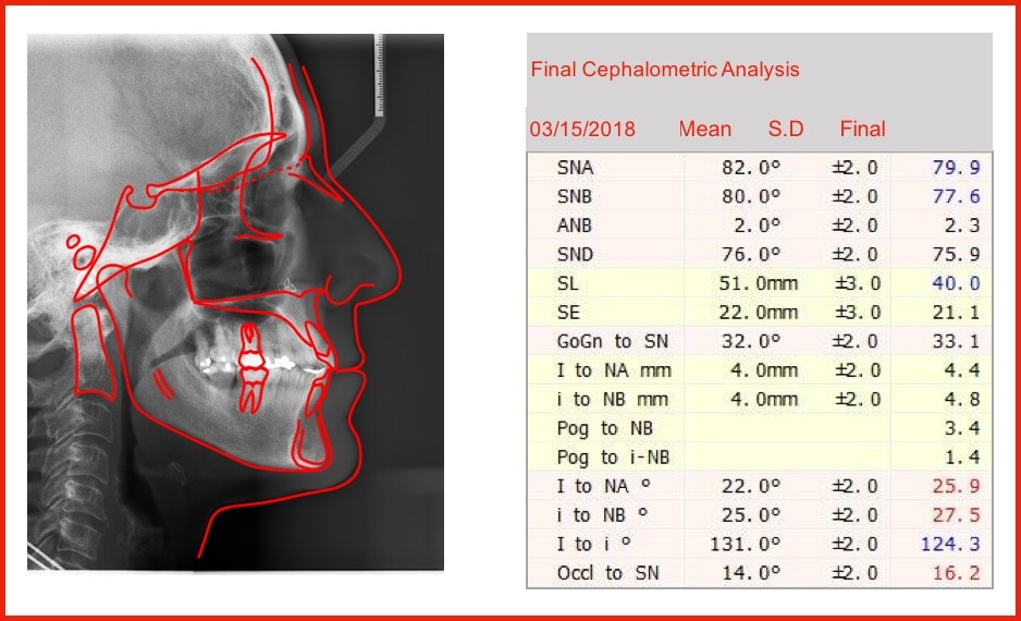 Table 5: Final Cephalometric Analysis