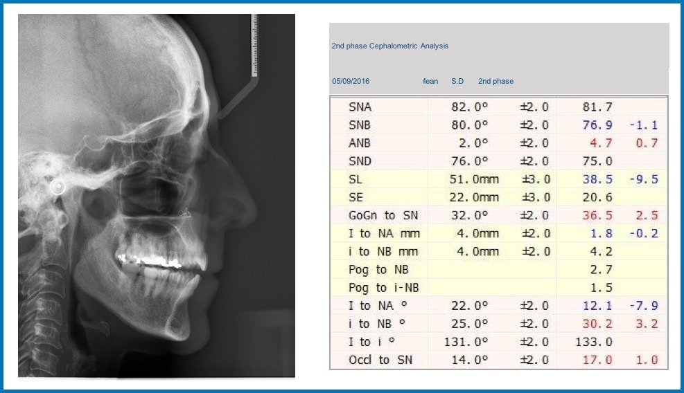 Table 2: 2nd Phase Cephalometric Analysis