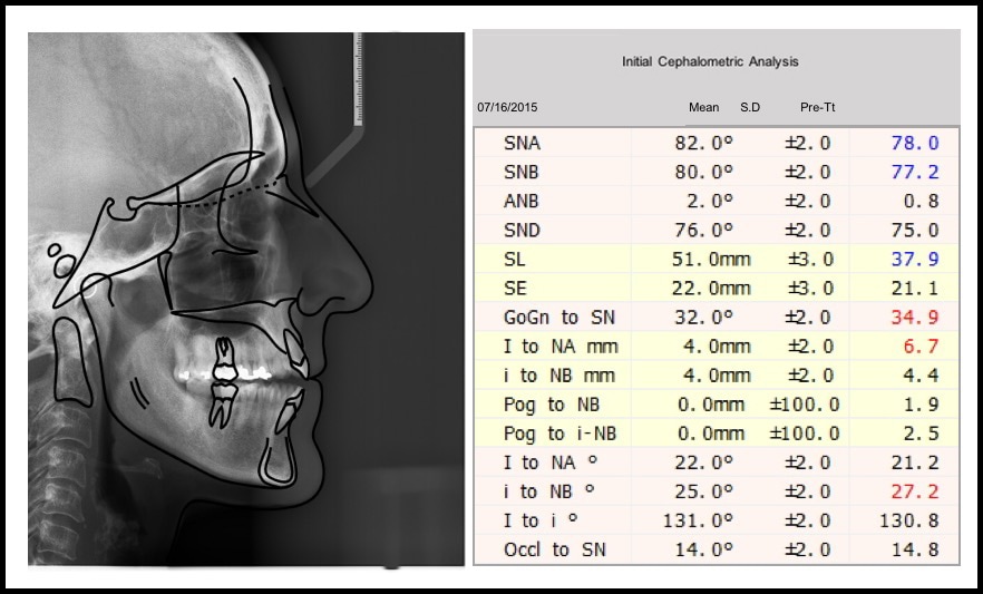 Table 1: Initial Cephalometric Analysis