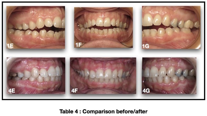 Table 5: Final Cephalometric Analysis